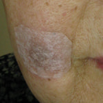 Qスイッチルビーレーザー治療後のアフターケア