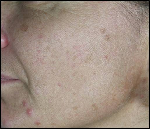 CO2フラクショナルレーザーによる肌の若返り治療前