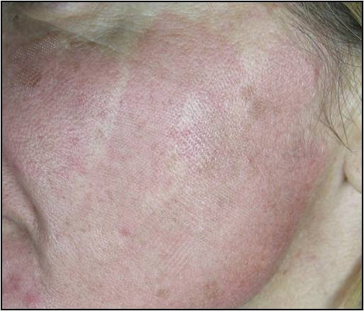 CO2フラクショナルレーザーによる肌の若返り治療直後