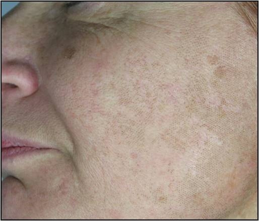 CO2フラクショナルレーザーによる肌の若返り治療7日後