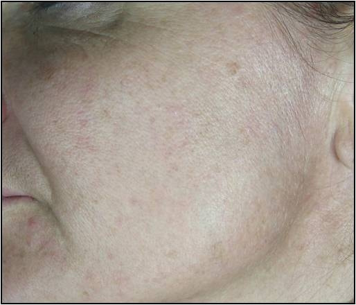 CO2フラクショナルレーザーによる肌の若返り治療2ヶ月後