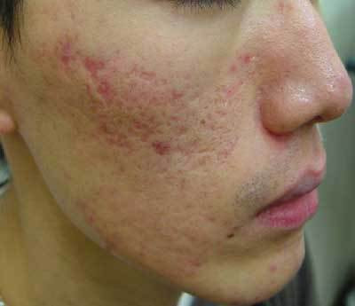 CO2フラクショナルレーザーによるニキビ跡治療前