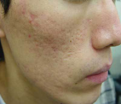 CO2フラクショナルレーザーによるニキビ跡治療後