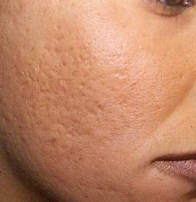 CO2フラクショナルレーザーによるニキビ跡治療前