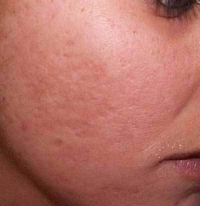 CO2フラクショナルレーザーによるニキビ跡治療後