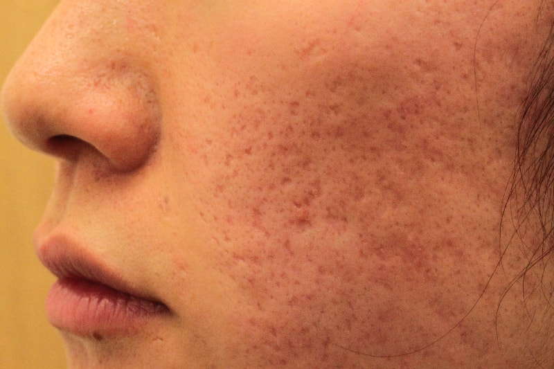 CO2フラクショナルレーザーによるニキビ跡治療前