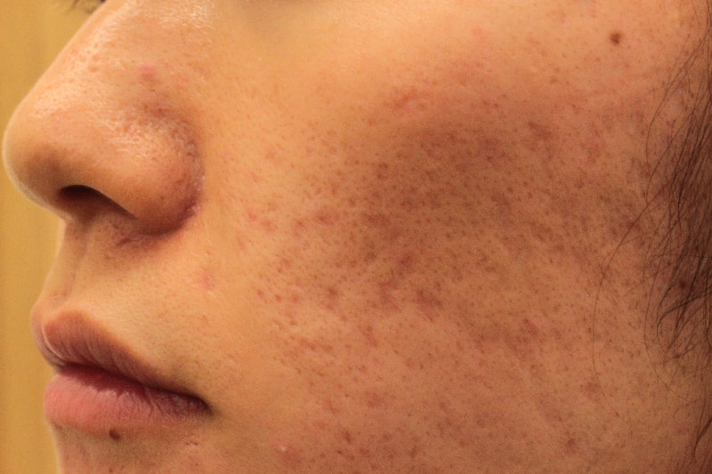 CO2フラクショナルレーザーによるニキビ跡4回治療後