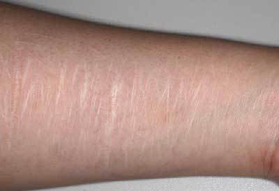 CO2フラクショナルレーザーによるリストカット痕治療前