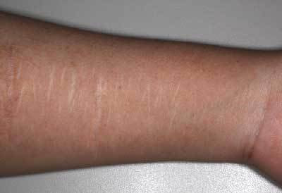 CO2フラクショナルレーザーによるリストカット痕5回治療後