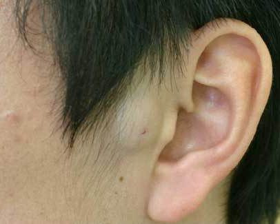 顔の粉瘤 手術前