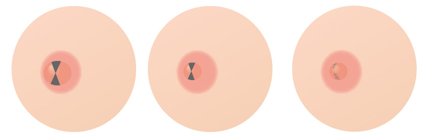 乳頭を小さくする場合