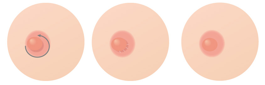 乳頭を低くする場合