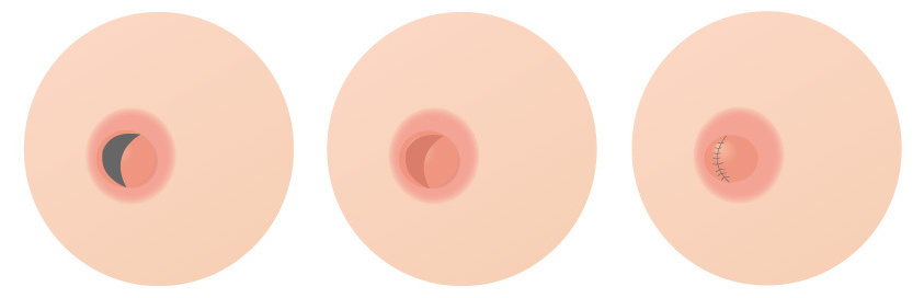 乳頭を低く小さくする場合