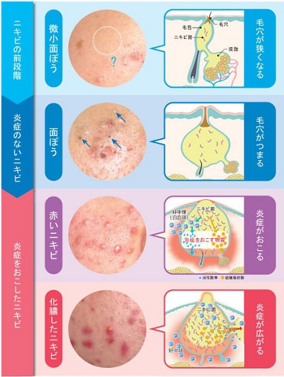 ニキビ しむら皮膚科クリニック 新潟市 ニキビ しむら皮膚科クリニック 新潟市