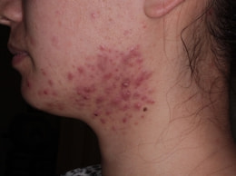 ホルモン治療 スピロノラクトン しむら皮膚科クリニック 新潟市 ホルモン治療 スピロノラクトン しむら皮膚科クリニック 新潟市