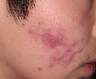 にきび イソトレチノイン ロアキュテイン アキュテイン しむら皮膚科クリニック 新潟市 にきび イソトレチノイン ロアキュテイン アキュテイン しむら皮膚科クリニック 新潟市