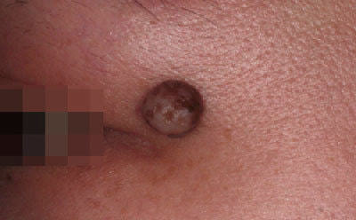 ほくろ 手術 黒子 除去 しむら皮膚科クリニック 新潟市 ほくろ 手術 黒子 除去 しむら皮膚科クリニック 新潟市