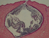 粉瘤の断面図