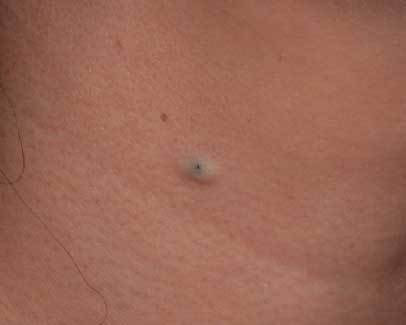 粉瘤 ふんりゅう くり抜き法 手術 しむら皮膚科クリニック 新潟市 粉瘤 ふんりゅう くり抜き法 手術 しむら皮膚科クリニック 新潟市