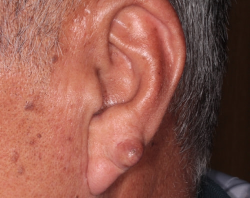 耳の粉瘤　手術前
