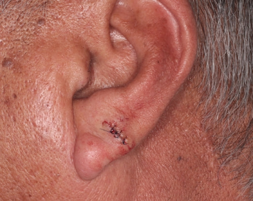耳の粉瘤　手術直後