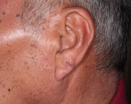 耳の粉瘤　手術後１週間