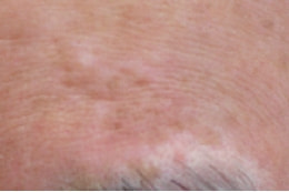 尋常性白斑 ミニグラフト法 植皮術 皮膚移植術 しむら皮膚科クリニック 新潟市