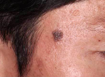 ほくろ 汗管腫 アクロコルドン 炭酸ガスレーザー Co2ガスレーザー手術 しむら皮膚科クリニック 新潟市