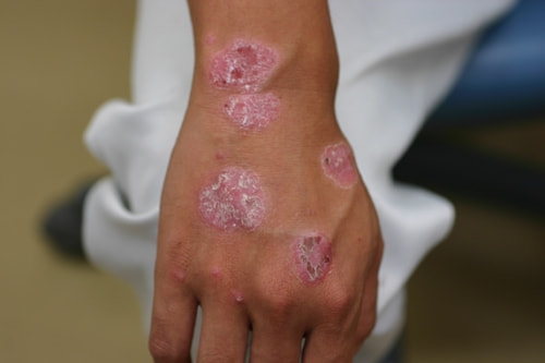 ナローバンドuvb 全身照射型 しむら皮膚科クリニック 新潟市 ナローバンドuvb 全身照射型 しむら皮膚科クリニック 新潟市