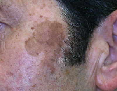 治療前の頬部に生じた老人性色素斑