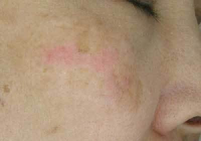 新潟市でしみをレーザーで治療するならqスイッチルビーレーザーが出来るしむら皮膚科クリニックへ しむら皮膚科クリニック 新潟市 新潟市でしみをレーザーで治療するならqスイッチルビーレーザーが出来るしむら皮膚科クリニックへ しむら皮膚科クリニック 新潟市