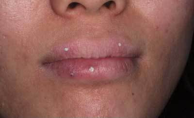 新潟市でしみをレーザーで治療するならqスイッチルビーレーザーが出来るしむら皮膚科クリニックへ しむら皮膚科クリニック 新潟市 新潟市でしみをレーザーで治療するならqスイッチルビーレーザーが出来るしむら皮膚科クリニックへ しむら皮膚科クリニック 新潟市