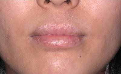 新潟市でしみをレーザーで治療するならqスイッチルビーレーザーが出来るしむら皮膚科クリニックへ しむら皮膚科クリニック 新潟市