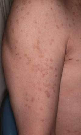 新潟市でしみをレーザーで治療するならqスイッチルビーレーザーが出来るしむら皮膚科クリニックへ しむら皮膚科クリニック 新潟市 新潟市でしみをレーザーで治療するならqスイッチルビーレーザーが出来るしむら皮膚科クリニックへ しむら皮膚科クリニック 新潟市