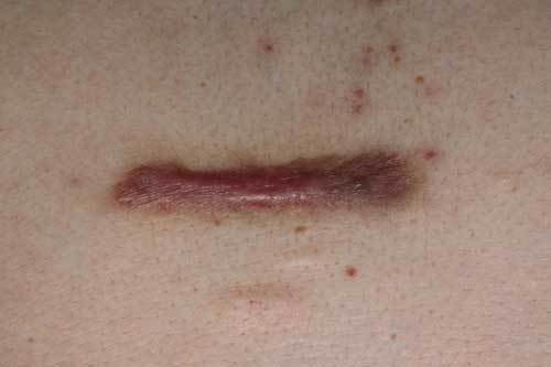 ケロイド 治療 5fu フラクショナルレーザー ステロイド しむら皮膚科クリニック 新潟市