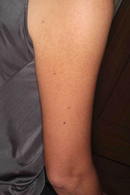 毛孔性苔癬 二の腕のぶつぶつ ダーマローラー ダーマペン しむら皮膚科クリニック 新潟市 毛孔性苔癬 二の腕のぶつぶつ ダーマローラー ダーマペン しむら皮膚科クリニック 新潟市