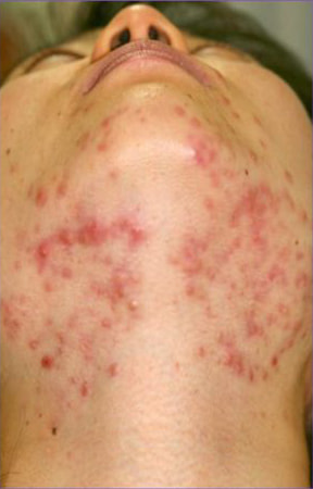 Agnes アグネス によるニキビ治療 しむら皮膚科クリニック 新潟市 Agnes アグネス によるニキビ治療 しむら皮膚科クリニック 新潟市