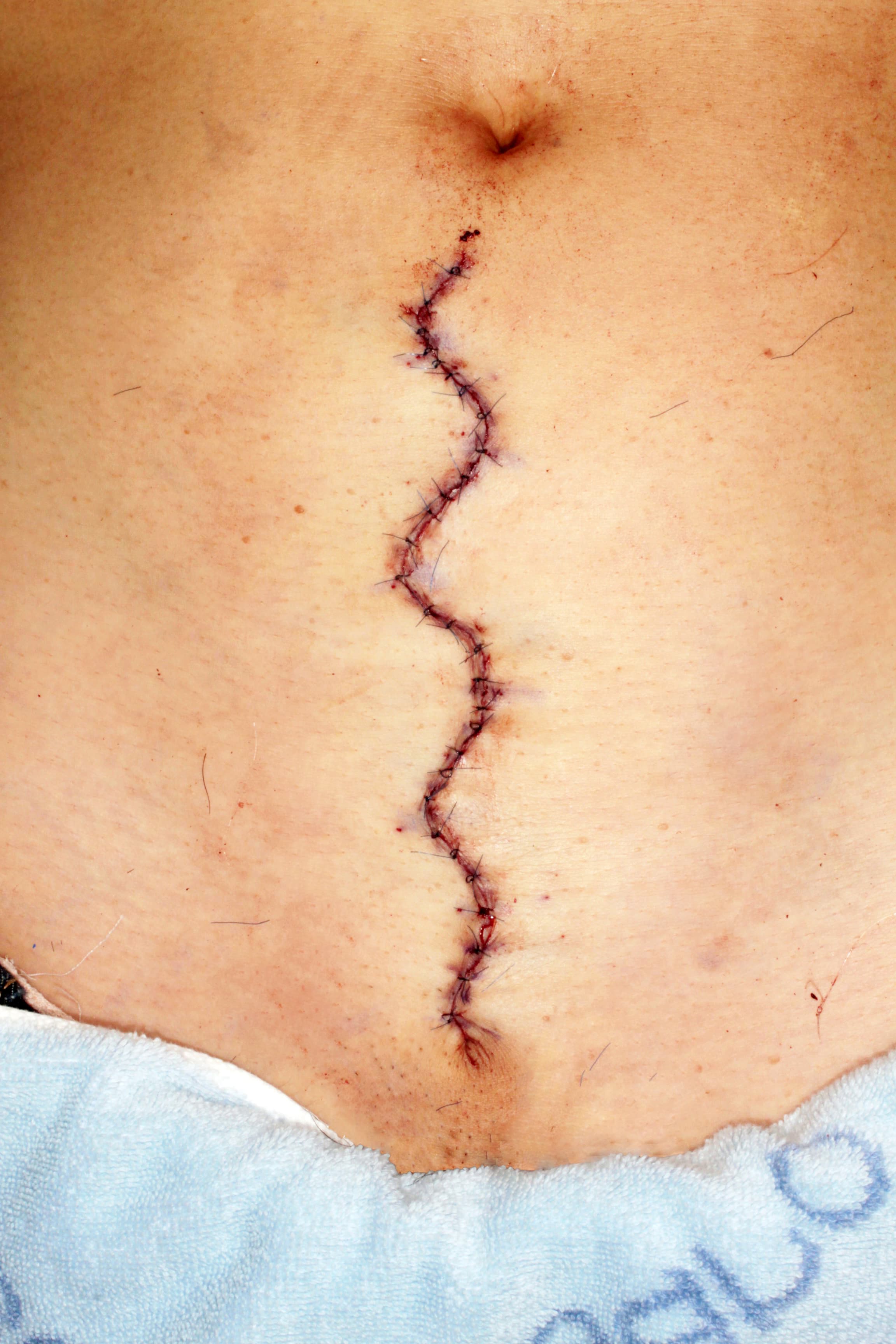 腹部の肥厚性瘢痕　手術直後