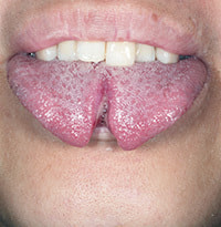 スプリットタンイメージ