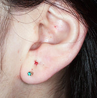 ピアス穴の修正 しむら皮膚科クリニック 新潟市 ピアス穴の修正 しむら皮膚科クリニック 新潟市