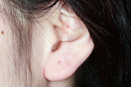 ピアス穴の修正 しむら皮膚科クリニック 新潟市 ピアス穴の修正 しむら皮膚科クリニック 新潟市