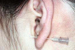 ピアス穴の修正 しむら皮膚科クリニック 新潟市 ピアス穴の修正 しむら皮膚科クリニック 新潟市