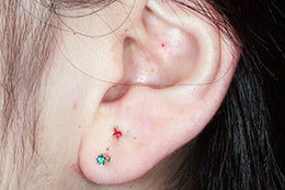 ピアス穴の修正 しむら皮膚科クリニック 新潟市 ピアス穴の修正 しむら皮膚科クリニック 新潟市