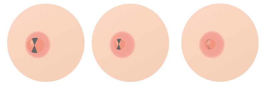 乳頭を小さくする場合