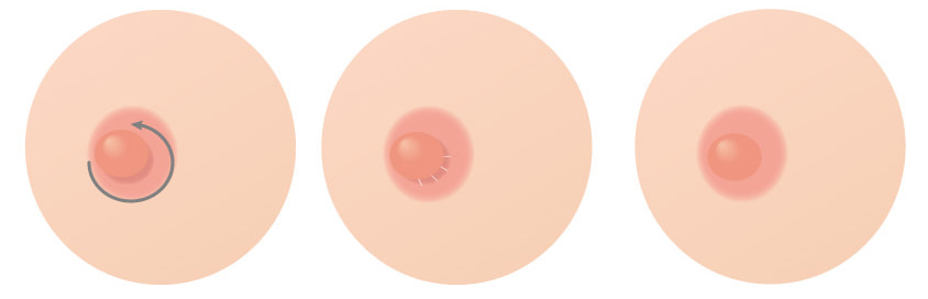 乳頭を低くする場合