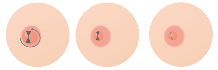 乳頭を低く小さくする場合