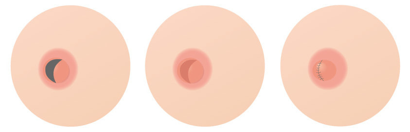 乳頭を低く小さくする場合