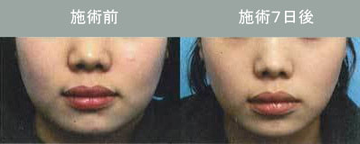 Bnls注射 脂肪溶解注射 小顔注射 輪郭注射 メソセラピー しむら皮膚科クリニック 新潟市 Bnls注射 脂肪溶解注射 小顔注射 輪郭注射 メソセラピー しむら皮膚科クリニック 新潟市