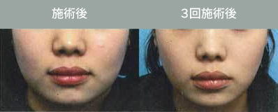 Bnls注射 脂肪溶解注射 小顔注射 輪郭注射 メソセラピー しむら皮膚科クリニック 新潟市 Bnls注射 脂肪溶解注射 小顔注射 輪郭注射 メソセラピー しむら皮膚科クリニック 新潟市