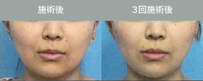 Bnls注射 脂肪溶解注射 小顔注射 輪郭注射 メソセラピー しむら皮膚科クリニック 新潟市 Bnls注射 脂肪溶解注射 小顔注射 輪郭注射 メソセラピー しむら皮膚科クリニック 新潟市